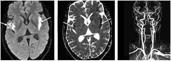 肺與腦的那些事--那些肺部病變相關的神經科疾病